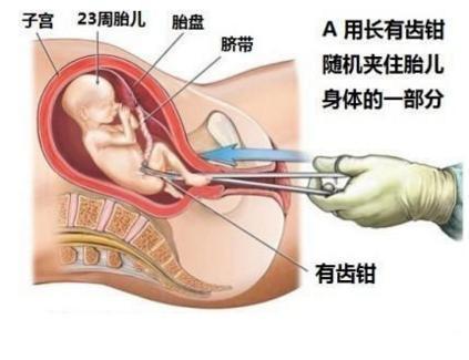 一个月能堕胎吗,一个月能堕胎吗，关于早期终止妊娠的探讨