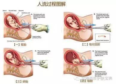 三个月人流两次,三个月人流两次，背后的故事与挑战