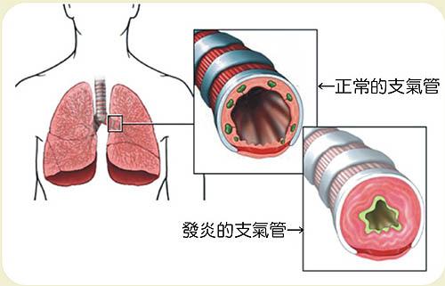 七个月宝宝支气管炎,七个月宝宝支气管炎，了解、预防与治疗